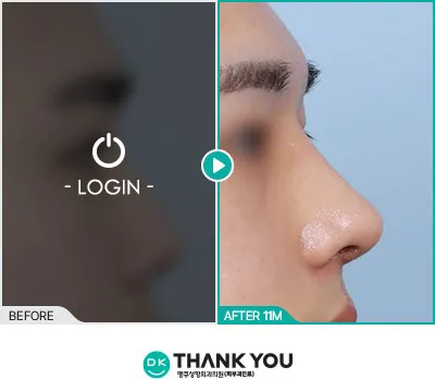 Before/After