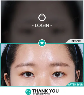 Before/After