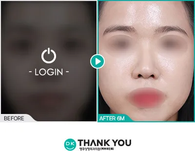 Before/After
