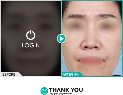 Before/After