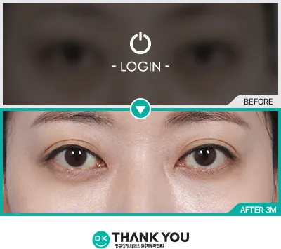 Before/After