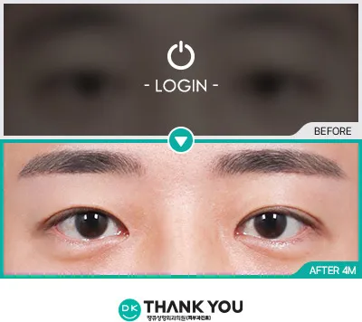 Before/After