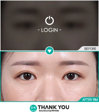 Before/After