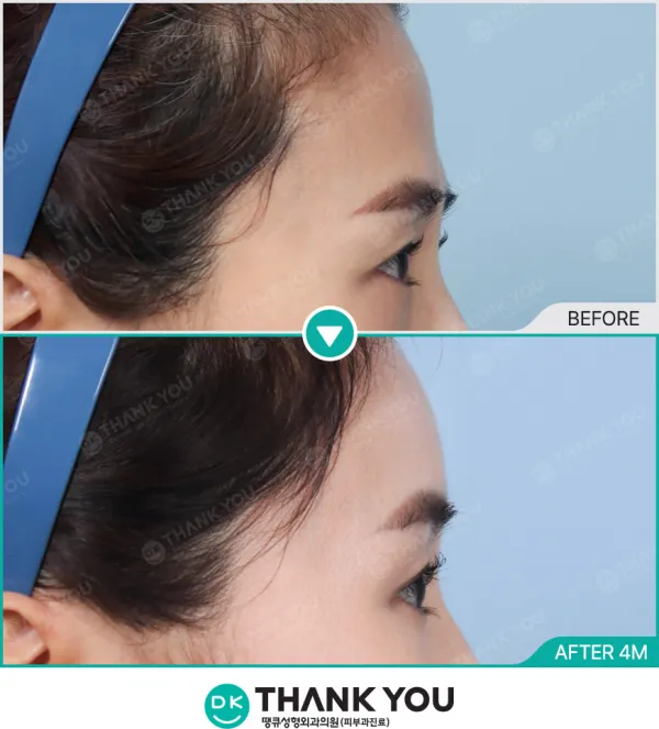 Before/After