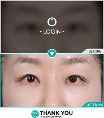 Before/After
