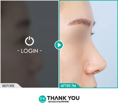 Before/After