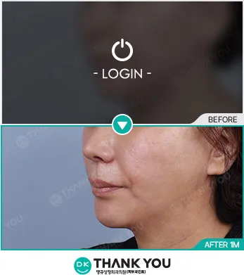 Before/After