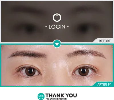 Before/After