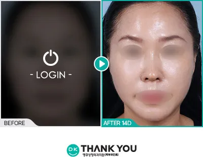 Before/After