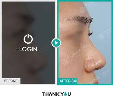 Before/After