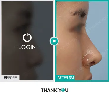 Before/After