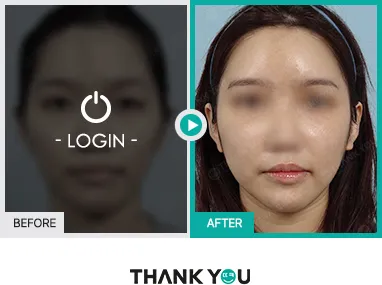Before/After