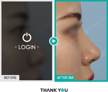 Before/After