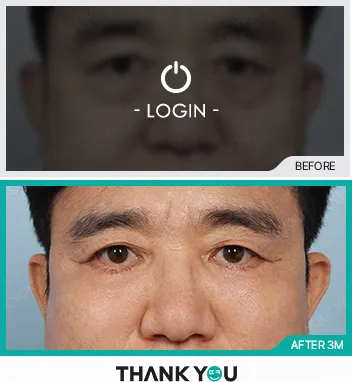 Before/After
