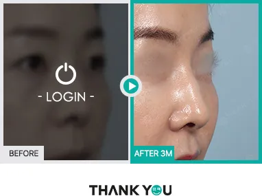 Before/After