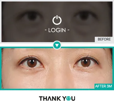 Before/After