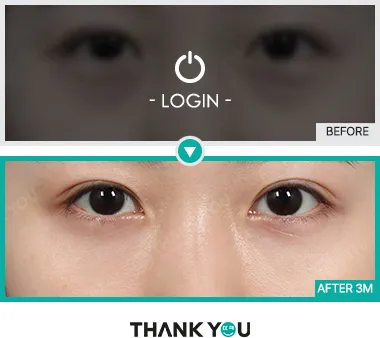 Before/After