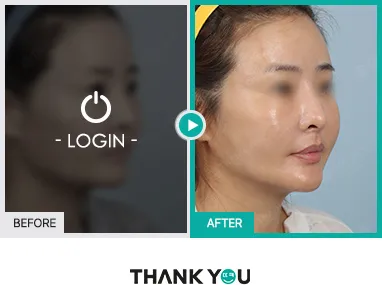 Before/After