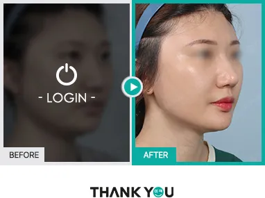 Before/After