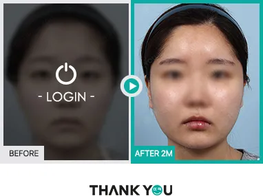 Before/After