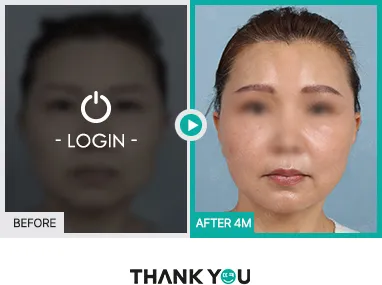Before/After