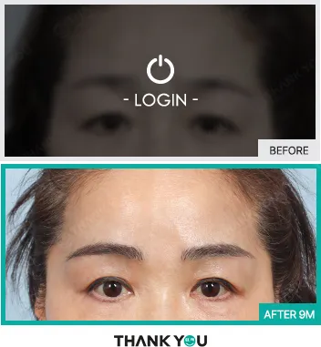 Before/After
