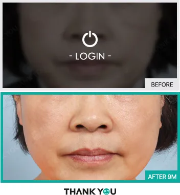 Before/After