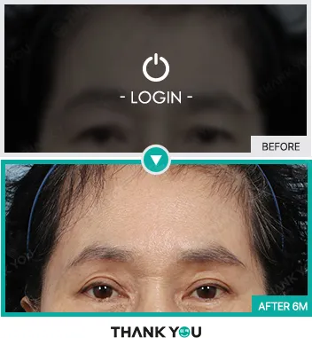 Before/After