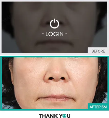 Before/After