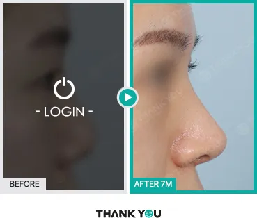 Before/After