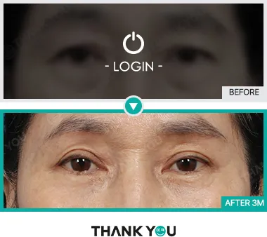 Before/After