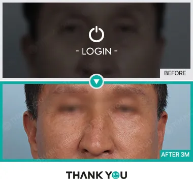 Before/After