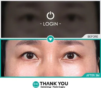 Before/After