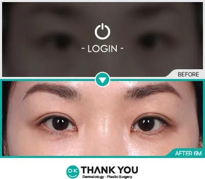 Before/After
