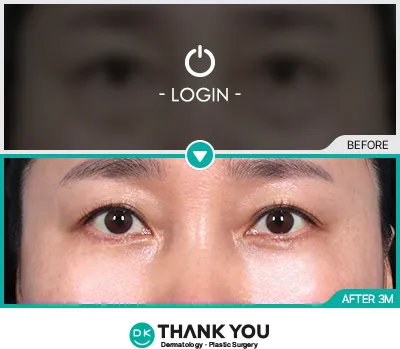 Before/After