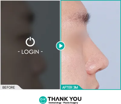Before/After