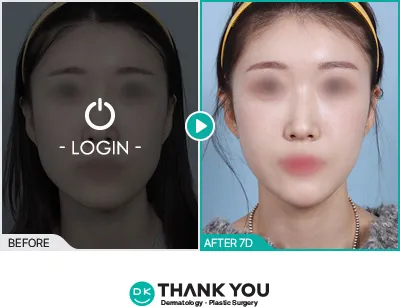 Before/After