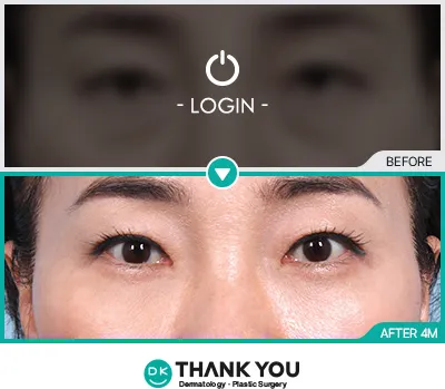 Before/After