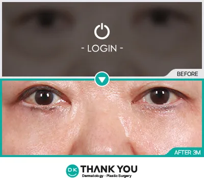 Before/After