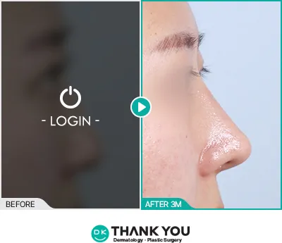 Before/After
