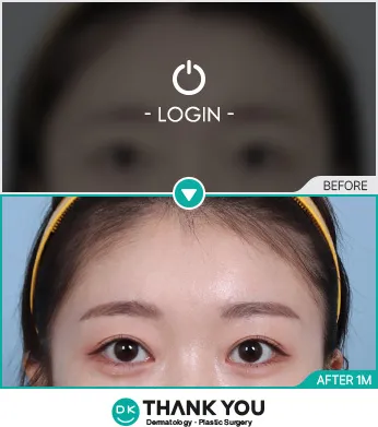 Before/After