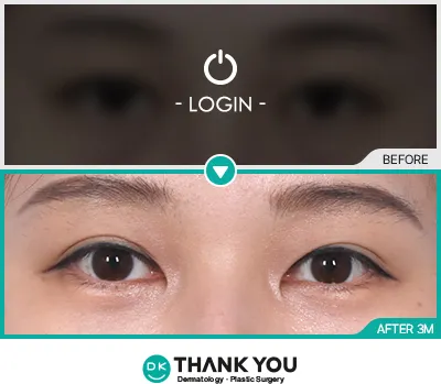 Before/After
