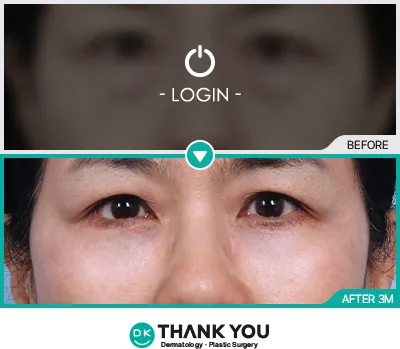 Before/After