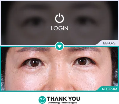Before/After