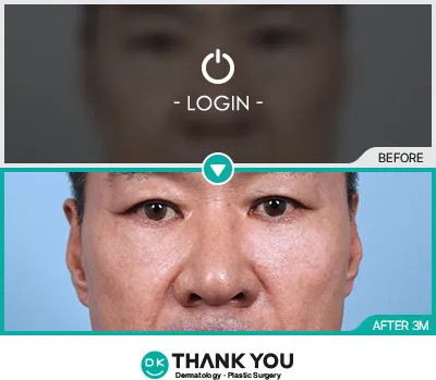 Before/After