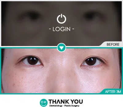 Before/After