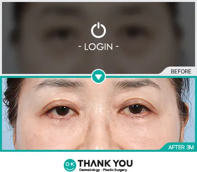 Before/After