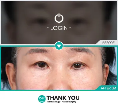 Before/After
