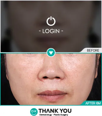 Before/After