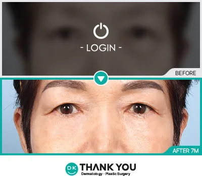 Before/After
